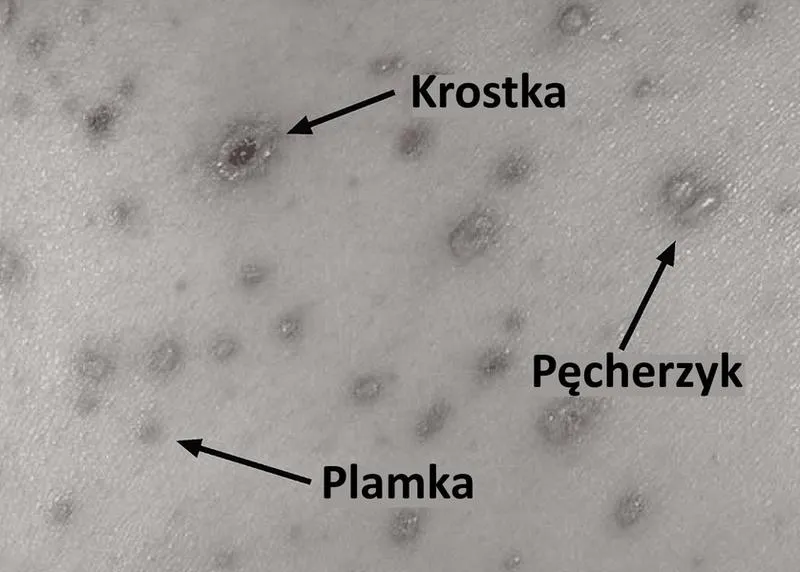 Ospa wietrzna u dzieci